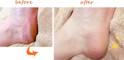 かかとの角質ケア