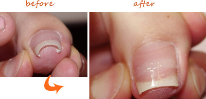 足指の巻爪補正ケア